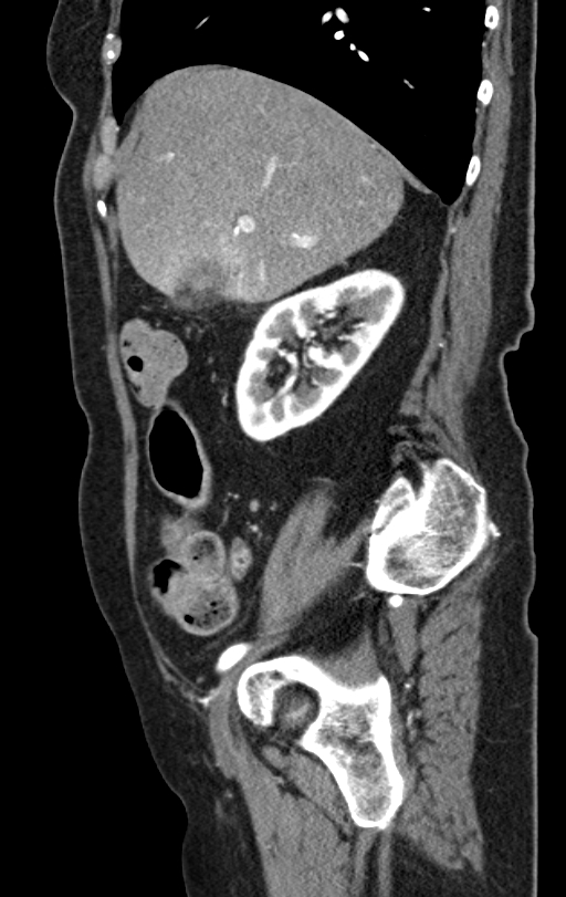 Cholecystoduodenal fistula due to calculous cholecystitis with gallstone migration (Radiopaedia 86875-103077 C 44).jpg