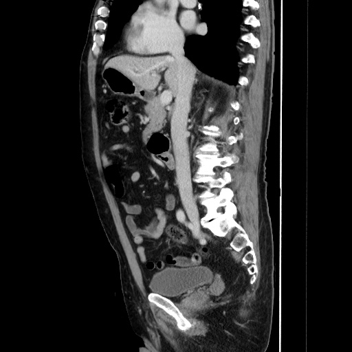 Choledocholiathiasis with normal caliber common bile duct (Radiopaedia 75368-86632 D 75).jpg