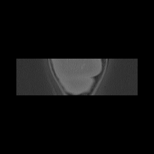 Cholesteatoma (Radiopaedia 84946-100455 Coronal bone window 179).jpg