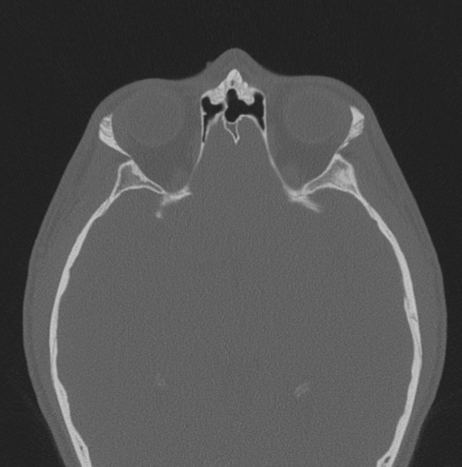 Chondrosarcoma (clivus) (Radiopaedia 46895-51425 Axial bone window 19).png
