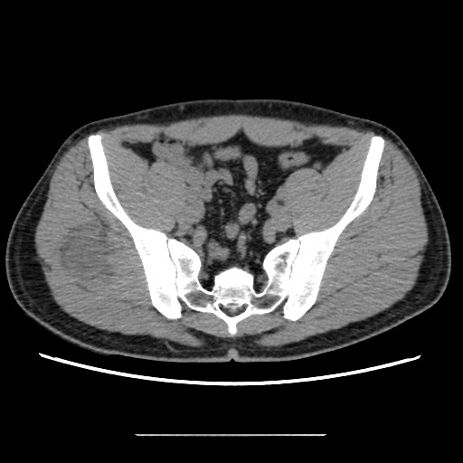 Chondrosarcoma of iliac wing (Radiopaedia 63861-72599 Axial non-contrast 65).jpg