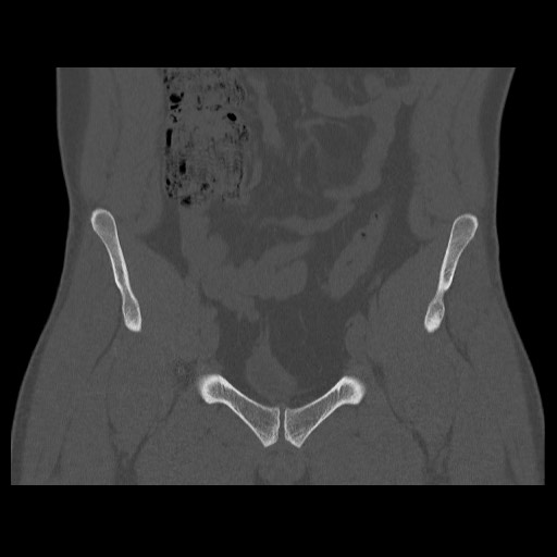 Chondrosarcoma of iliac wing (Radiopaedia 63861-72599 Coronal bone window 38).jpg