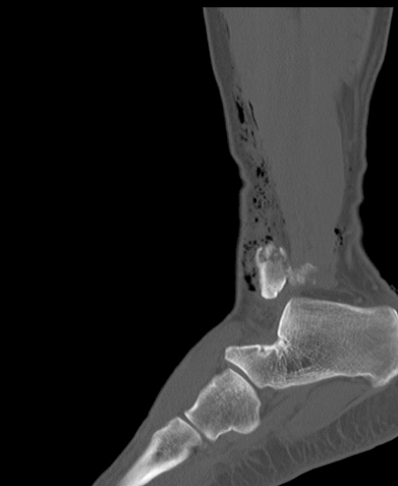 Chopart fracture (Radiopaedia 35347-36851 Sagittal bone window 48).jpg