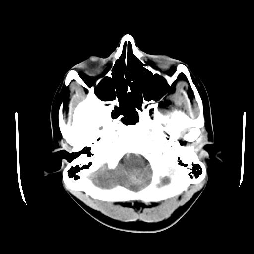 File:Choriocarcinoma of ovary with cerebral and pulmonary metastases (Radiopaedia 25983-26118 A 3).jpg