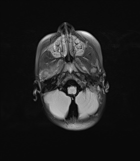File:Choroid plexus papilloma (Radiopaedia 84612-100019 Axial FLAIR 5).jpg