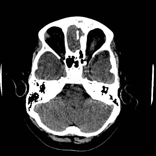 Choroid plexus xanthogranulomas (Radiopaedia 51621-57408 Axial non-contrast 21).jpg