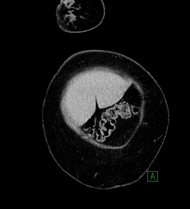 Chromophobe renal cell carcinoma (Radiopaedia 84239-99519 F 7).jpg