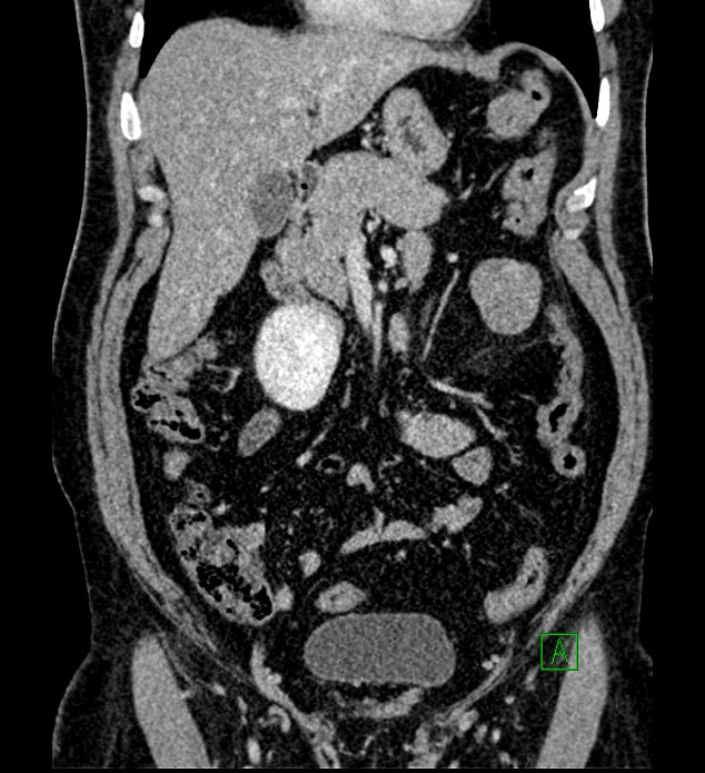 Chromophobe renal cell carcinoma (Radiopaedia 84286-99573 H 67).jpg