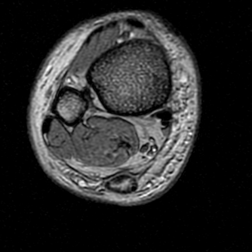 File:Chronic Achilles tendon rupture (Radiopaedia 15262-15100 Axial Gradient Echo 4).jpg
