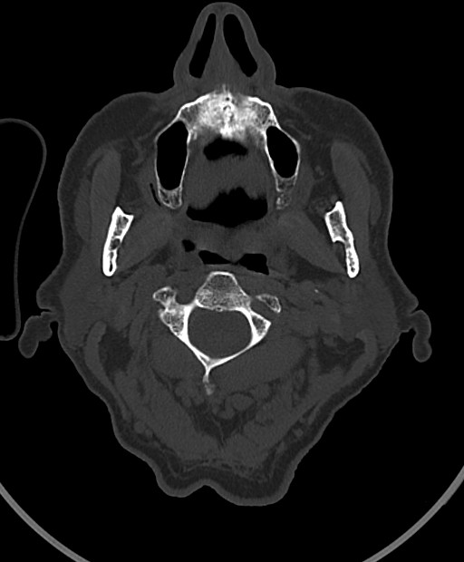 Chronic bilateral subdural hygroma (Radiopaedia 85801-101623 Axial bone window 123).jpg