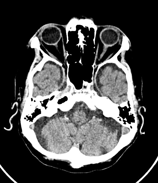 Chronic bilateral subdural hygroma (Radiopaedia 85801-101623 Axial non-contrast 47).jpg