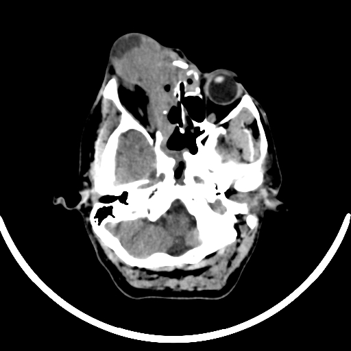 File:Chronic invasive fungal sinusitis with intraorbital and intracranial extension (Radiopaedia 56387-63046 Axial non-contrast 112).jpg