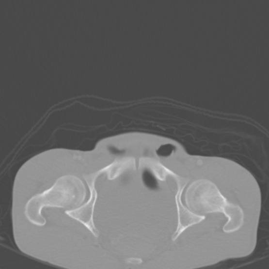 Chronic large bowel pseudo-obstruction (Radiopaedia 43181-46492 Axial bone window 158).jpg