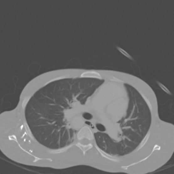 Chronic large bowel pseudo-obstruction (Radiopaedia 43181-46492 Axial bone window 7).jpg