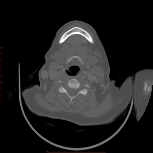Chronic osteomyelitis - maxilla (Radiopaedia 23783-23927 Axial bone window 9).jpg
