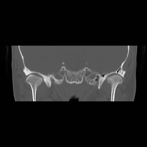 File:Chronic otomastoiditis (Radiopaedia 27138-27309 Coronal bone window 2).jpg