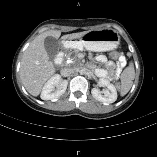 Chronic pancreatitis (Radiopaedia 64576-73450 C 49).jpg