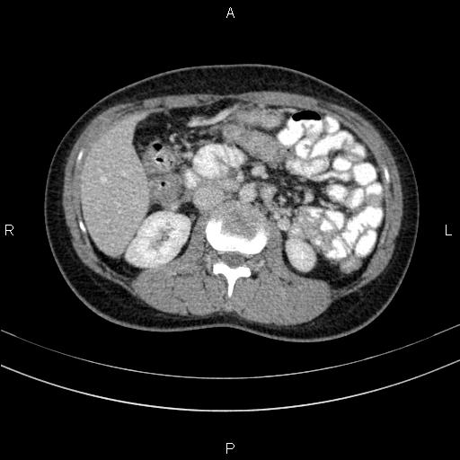 Chronic pancreatitis (Radiopaedia 64576-73450 C 73).jpg