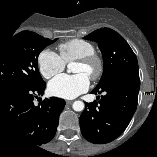 Chronic pulmonary embolism (Radiopaedia 73073-85094 Axial C+ CTPA 89).jpg