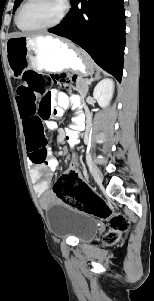 Chronic small bowel volvulus (Radiopaedia 75224-86322 C 59).jpg