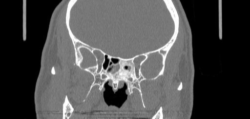 Chronic sphenoidal sinusitis (Radiopaedia 62030-70122 Coronal bone window 102).jpg