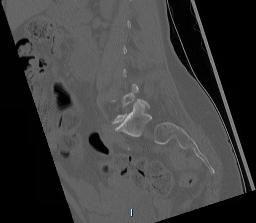 File:Chronic spinal hematoma with cauda equina syndrome (Radiopaedia 75745-88197 Sagittal bone window 1).png