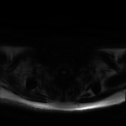 Chronic submandibular sialadenitis (Radiopaedia 61852-69885 Axial DWI 28).jpg