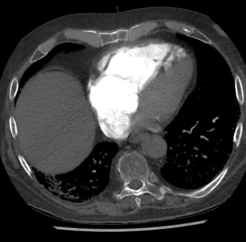 File:Chronic thromboembolic pulmonary disease (Radiopaedia 90694-108119 Axial C+ CTPA 69).jpg