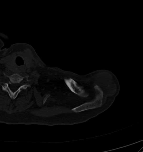 Clear cell chondrosarcoma - humerus (Radiopaedia 63104-71612 Axial bone window 11).jpg