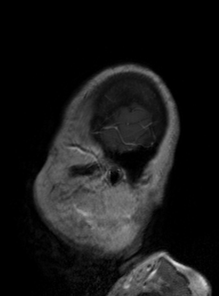 File:Clival meningioma (Radiopaedia 53278-59248 Sagittal T1 C+ 136).jpg