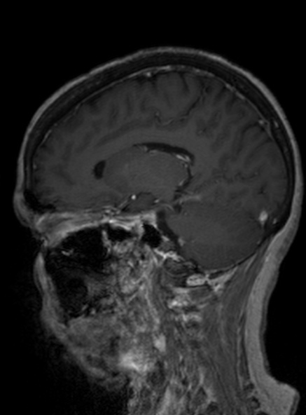 Clival meningioma (Radiopaedia 53278-59248 Sagittal T1 C+ 285).jpg