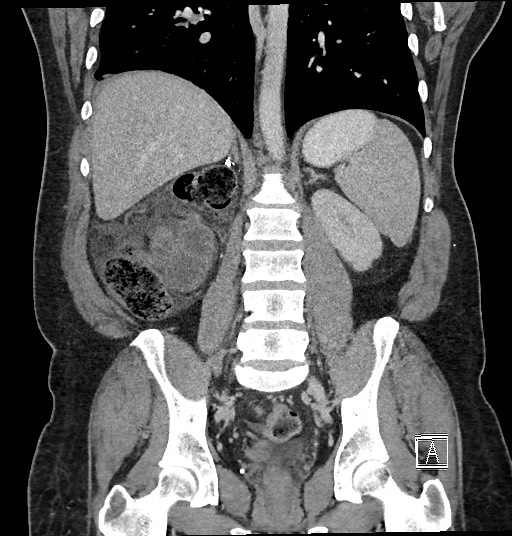 Closed loop obstruction - internal hernia into nephrectomy bed (Radiopaedia 59867-67320 B 93).jpg