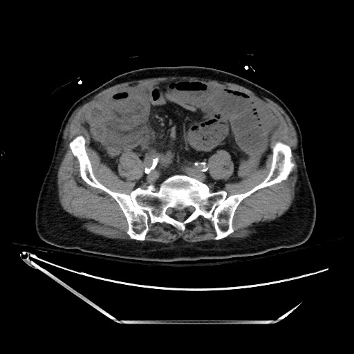 File:Closed loop obstruction due to adhesive band, resulting in small bowel ischemia and resection (Radiopaedia 83835-99023 Axial non-contrast 109).jpg