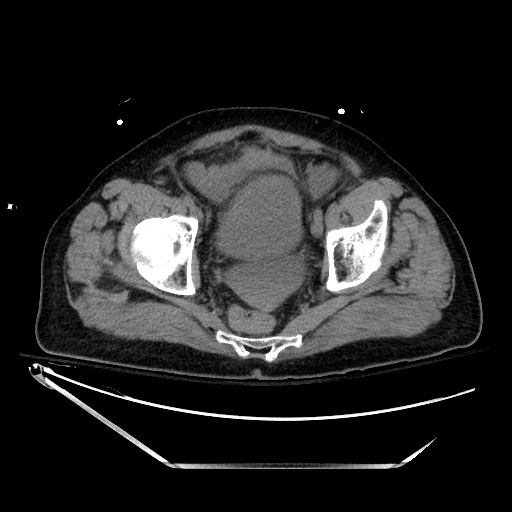 File:Closed loop obstruction due to adhesive band, resulting in small bowel ischemia and resection (Radiopaedia 83835-99023 Axial non-contrast 137).jpg