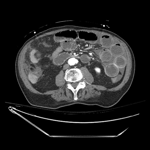 File:Closed loop obstruction due to adhesive band, resulting in small bowel ischemia and resection (Radiopaedia 83835-99023 B 80).jpg