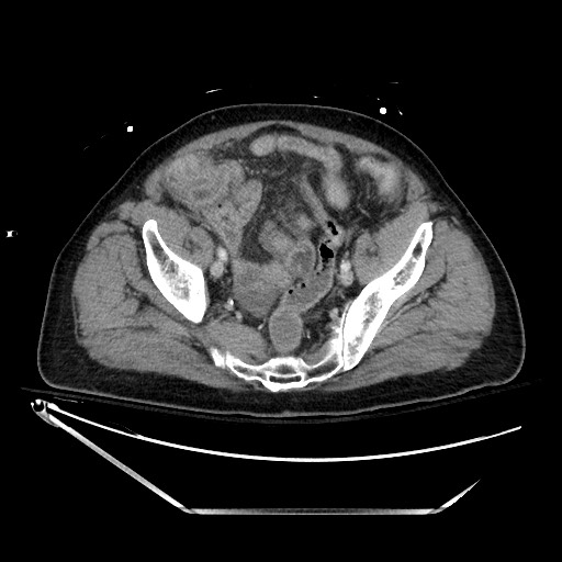 File:Closed loop obstruction due to adhesive band, resulting in small bowel ischemia and resection (Radiopaedia 83835-99023 D 127).jpg