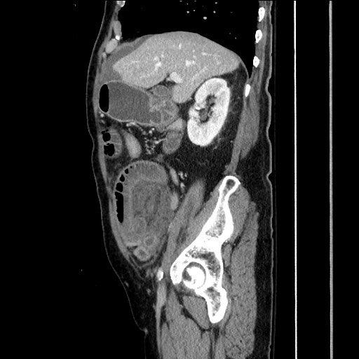 File:Closed loop obstruction due to adhesive band, resulting in small bowel ischemia and resection (Radiopaedia 83835-99023 F 64).jpg