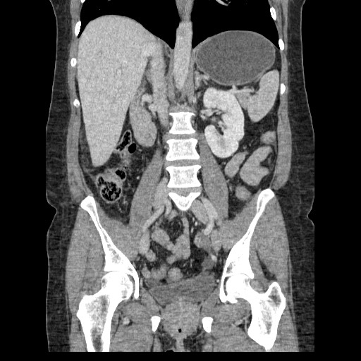 Closed loop small bowel obstruction (Radiopaedia 65403-74451 B 63).jpg