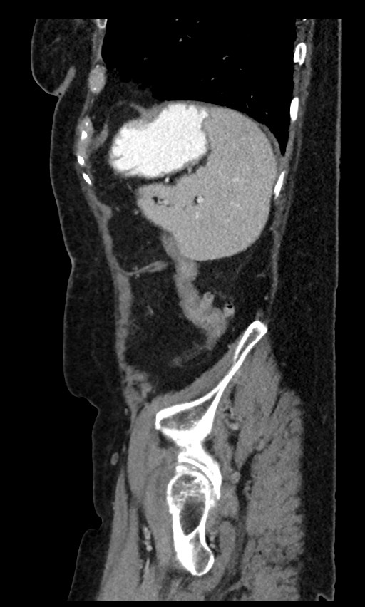 Closed loop small bowel obstruction - adhesions (Radiopaedia 59269-66611 C 23).jpg