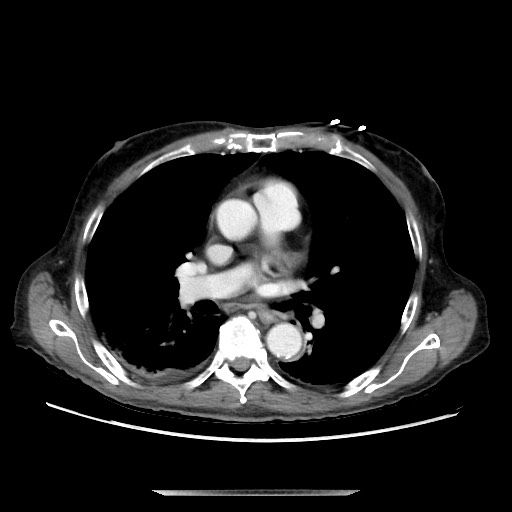 File:Closed loop small bowel obstruction - adhesive disease and hemorrhagic ischemia (Radiopaedia 86831-102990 A 4).jpg