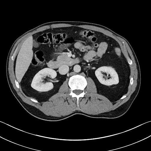 Closed loop small bowel obstruction - internal hernia (Radiopaedia 57806-64778 B 48).jpg