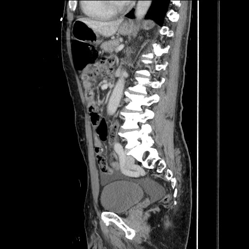 Closed loop small bowel obstruction - omental adhesion causing "internal hernia" (Radiopaedia 85129-100682 C 106).jpg