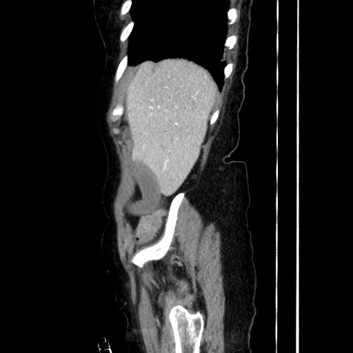 Closed loop small bowel obstruction due to adhesive band, with intramural hemorrhage and ischemia (Radiopaedia 83831-99017 D 50).jpg