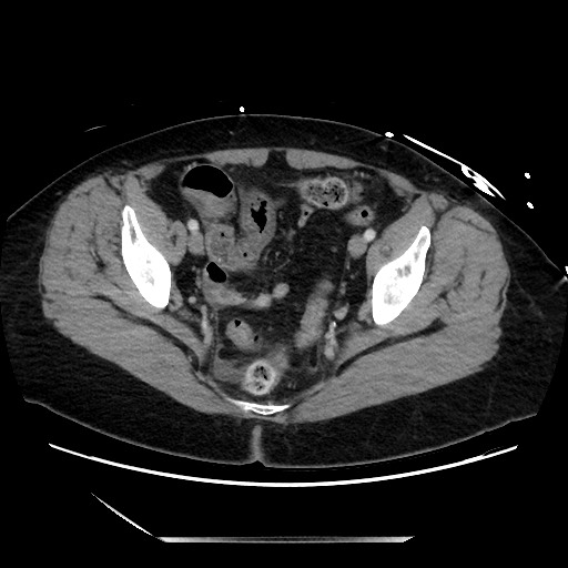 File:Closed loop small bowel obstruction due to adhesive bands - early and late images (Radiopaedia 83830-99014 A 132).jpg