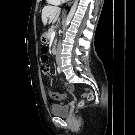 Closed loop small bowel obstruction due to adhesive bands - early and late images (Radiopaedia 83830-99014 C 91).jpg