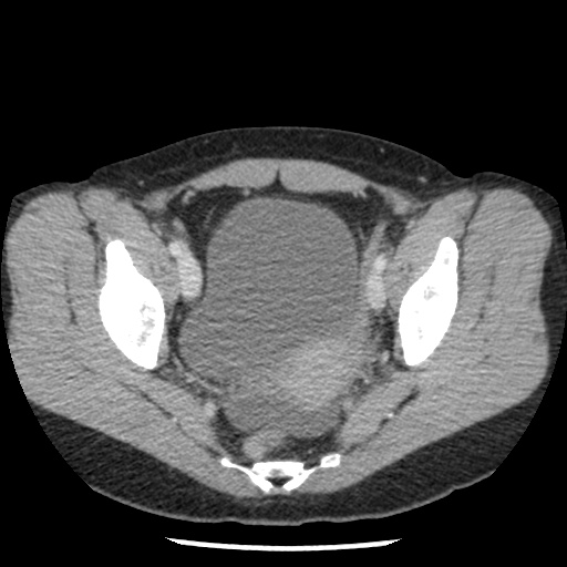 Closed loop small bowel obstruction due to trans-omental herniation (Radiopaedia 35593-37109 A 75).jpg