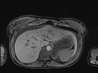 Closed loop small bowel obstruction in pregnancy (MRI) (Radiopaedia 87637-104031 Axial T1 fat sat 23).jpg