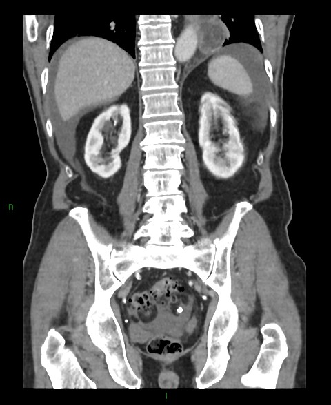 Closed loop small bowel obstruction with ischemia (Radiopaedia 84180-99456 B 19).jpg