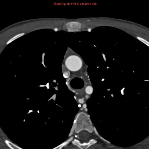 File:Coarctation of the aorta (Radiopaedia 12461-12697 A 109).jpg
