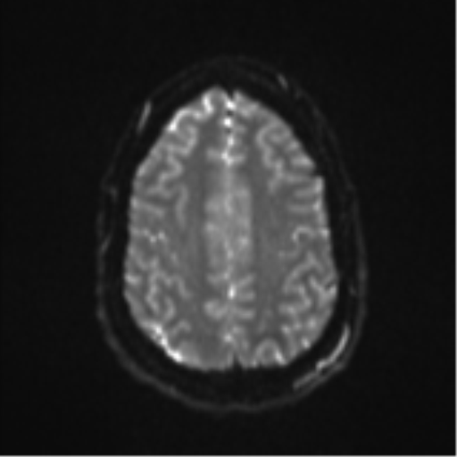 File:Colloid cyst (Radiopaedia 53164-59125 Axial DWI 23).png